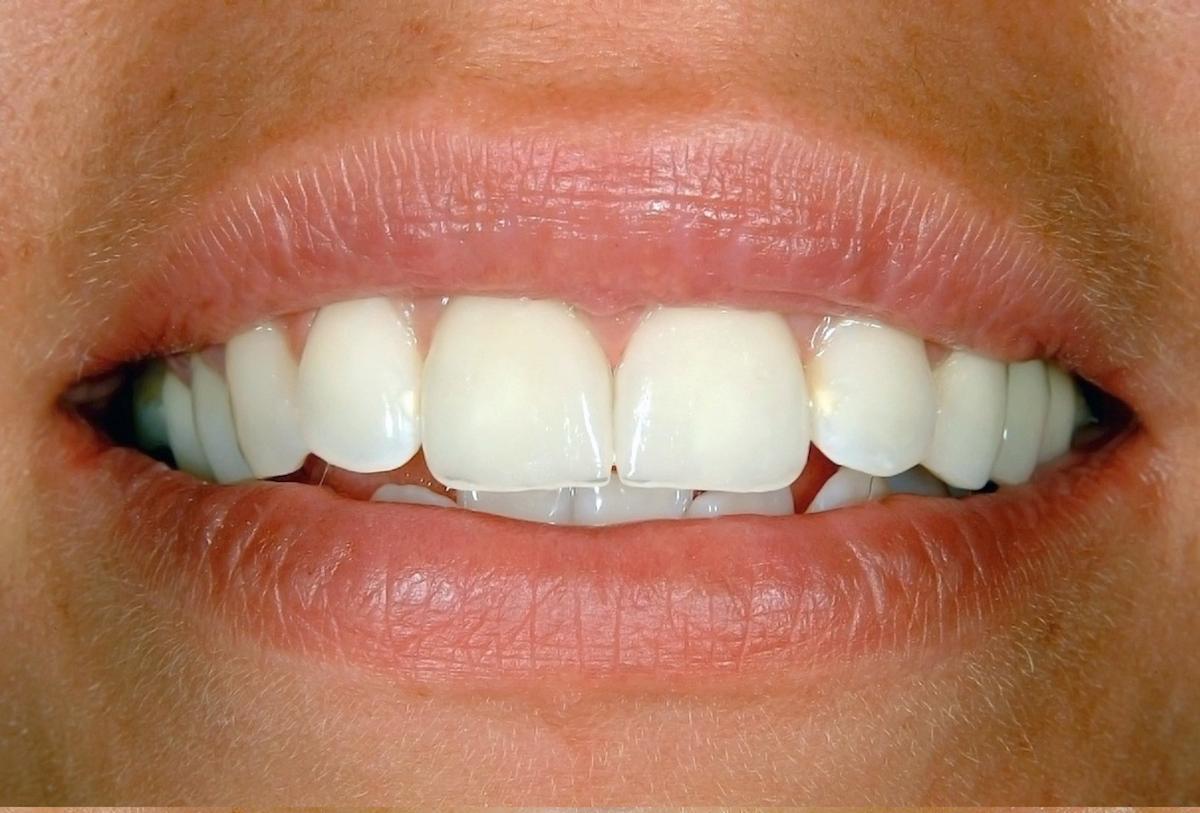 Laser Teeth Whitening System