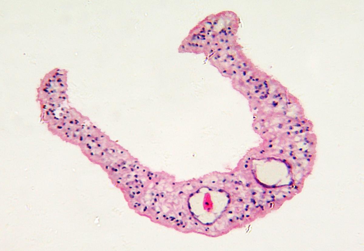 parasitic flatworms in humans