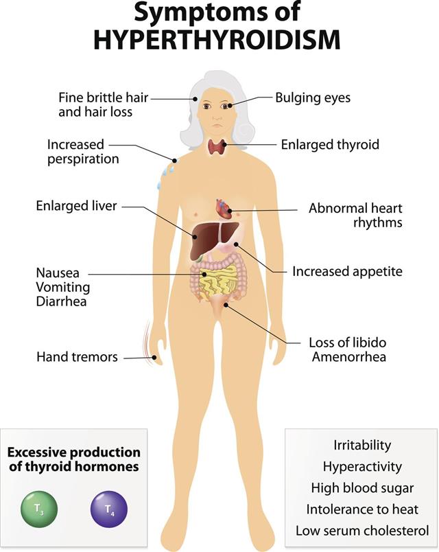 Hyperthyroidism and Symptoms