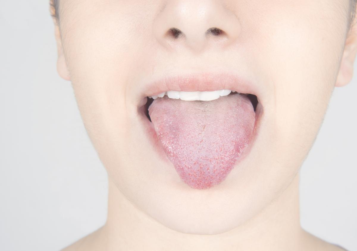 Yeast Infection in Mouth