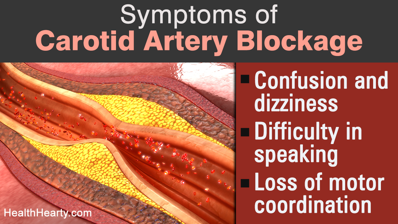 Carotid Artery Blockage Symptoms and Treatment
