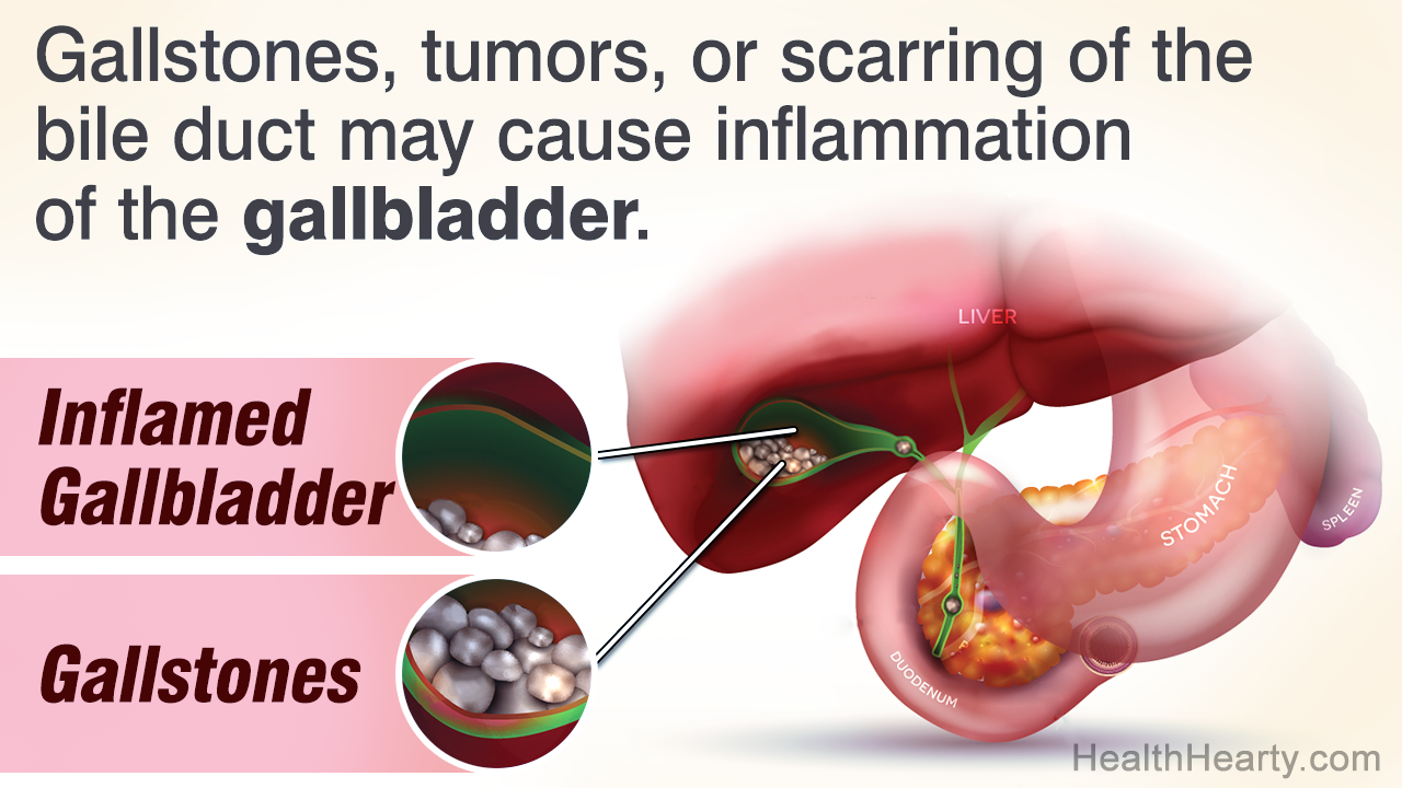 Gallbladder Problems - Symptoms of Gallbladder Diseases