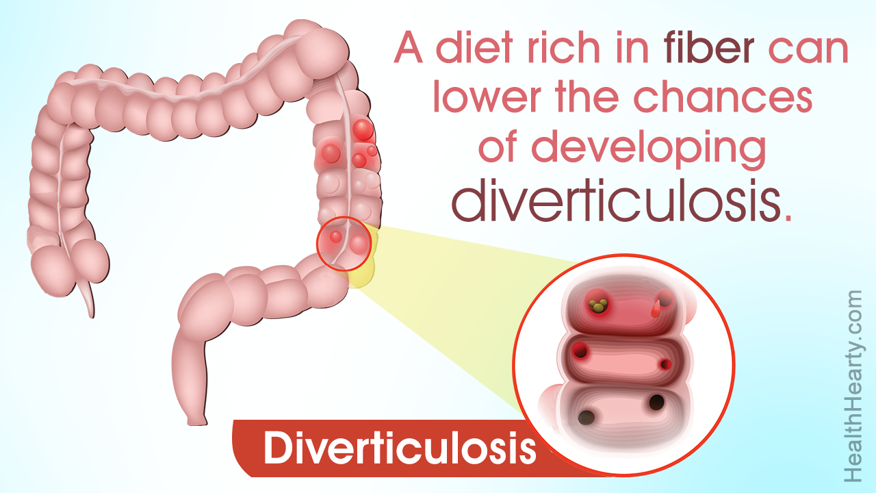 Diverticulosis Symptoms and Foods to Avoid with Diverticulosis