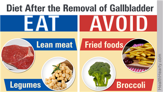  Gallbladder Removal Side Effects