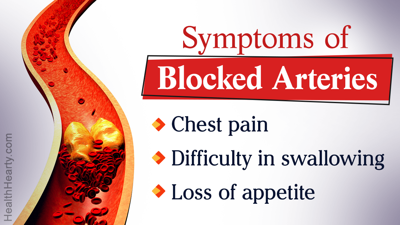 Blocked Arteries: Symptoms and Treatment