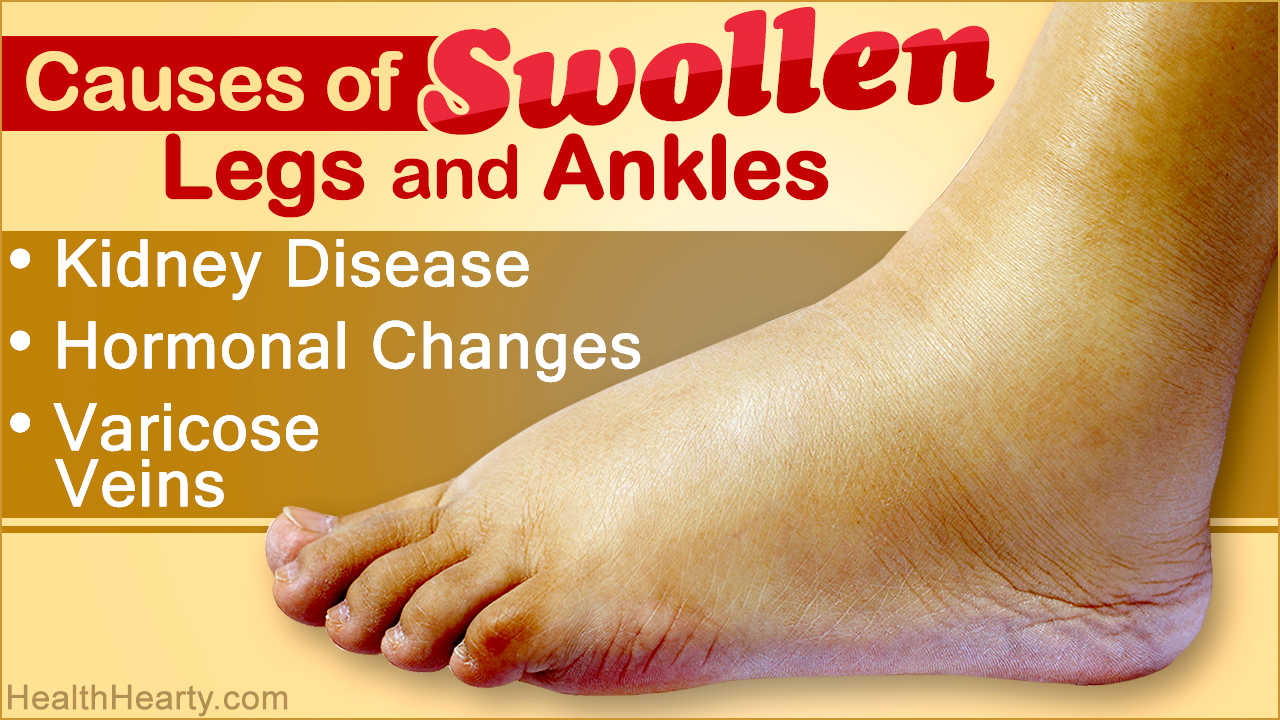 Causes of Swollen Legs and Ankles