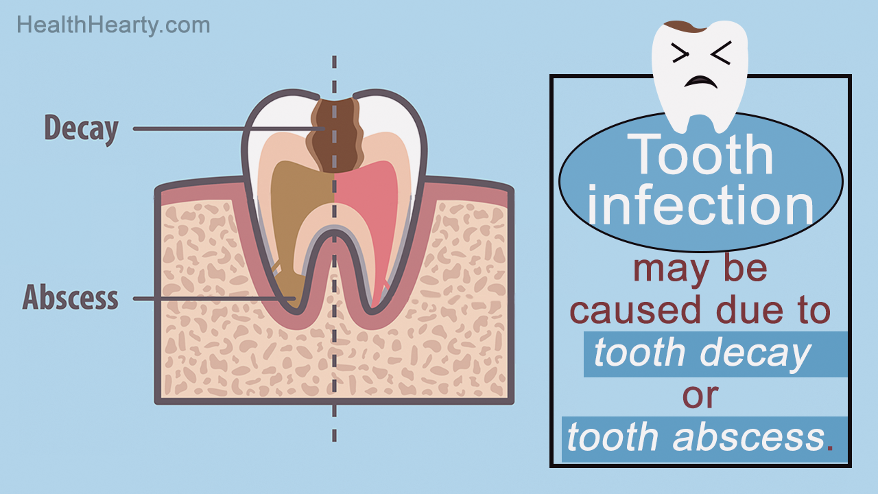 Infected Tooth Symptoms