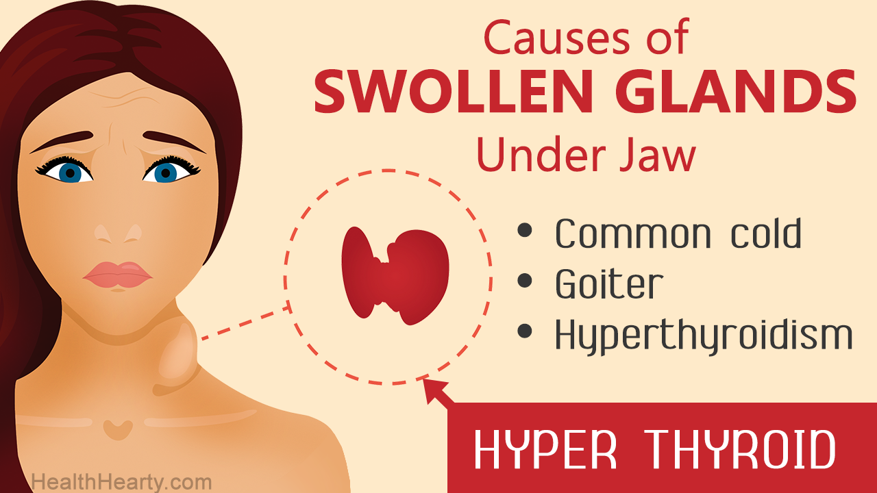 Swollen Glands Under Jaw