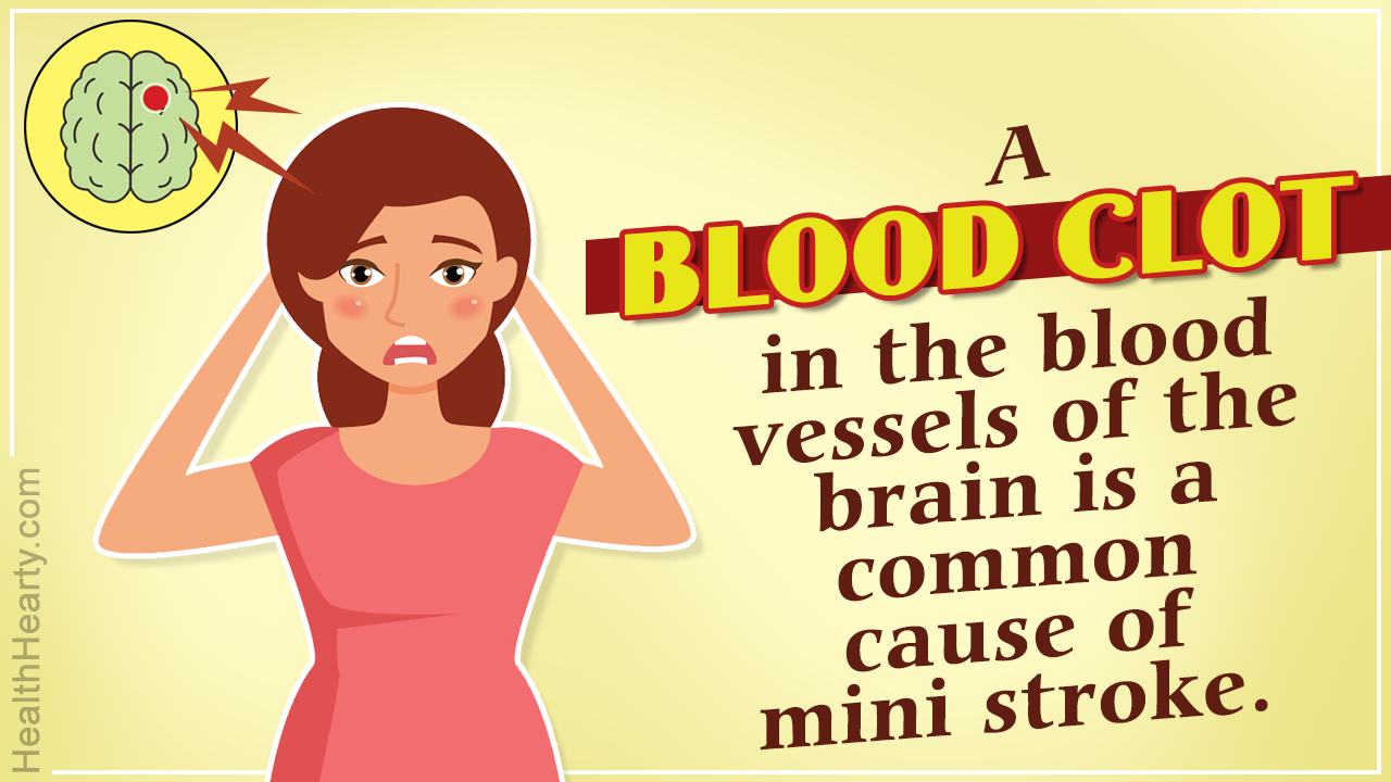Mini Stroke Symptoms for Women