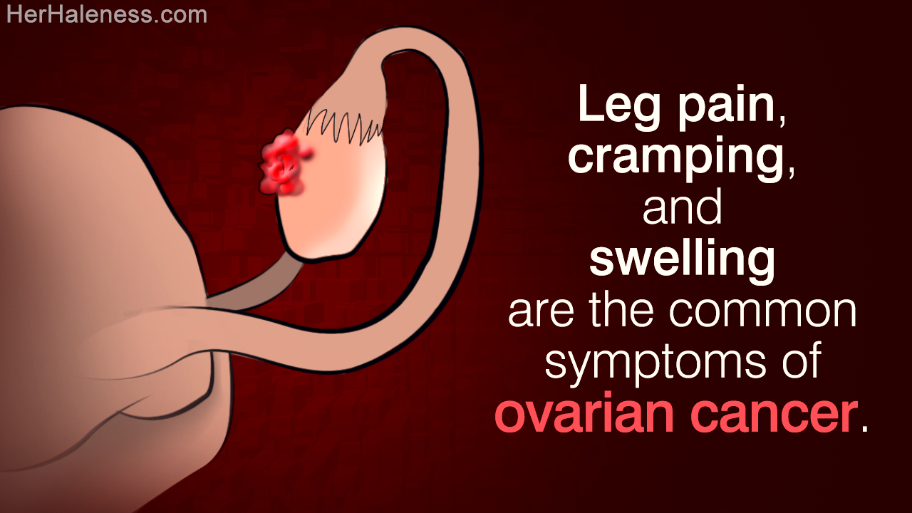 Ovarian Cancer and Leg Pain
