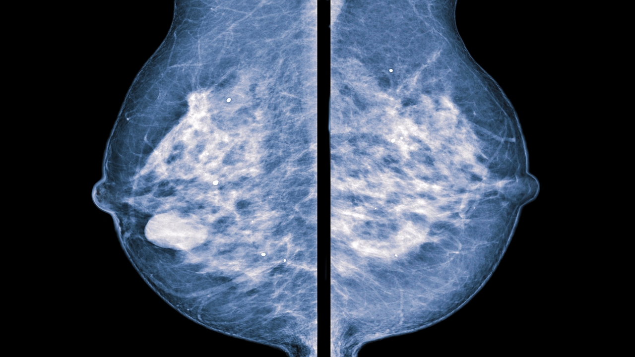 Calcium Deposits in Breast