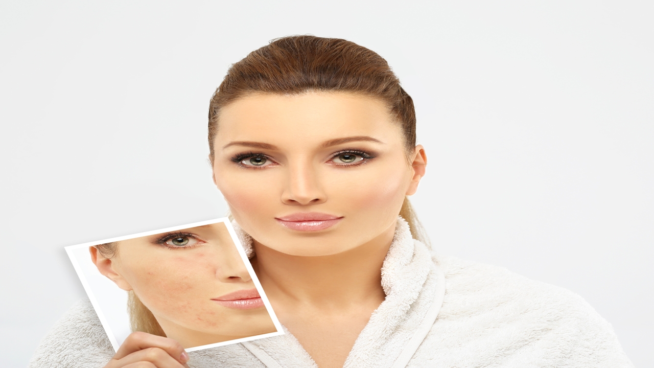 Chemical Peels for Acne