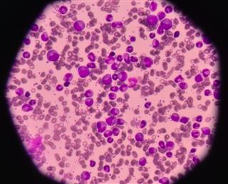 Leukemia Blood Cells