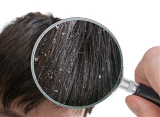 Examining White Dandruff Flakes In Hair