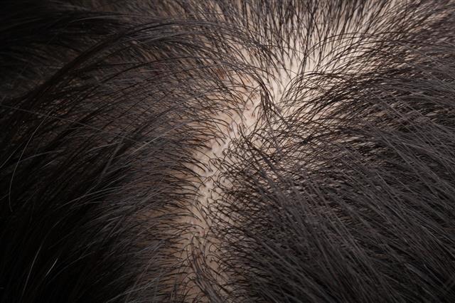 Thinning Hair And Scalp