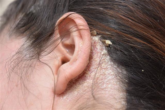 Woman With Serious Problem Of Dandruff