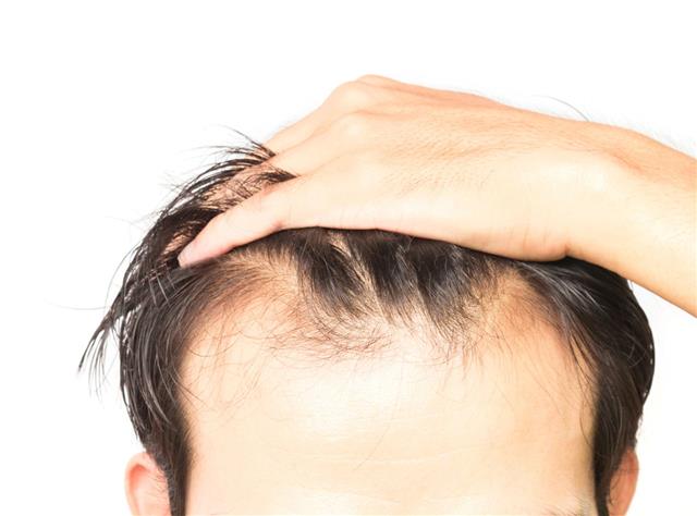 Man Having Hair Loss Problem