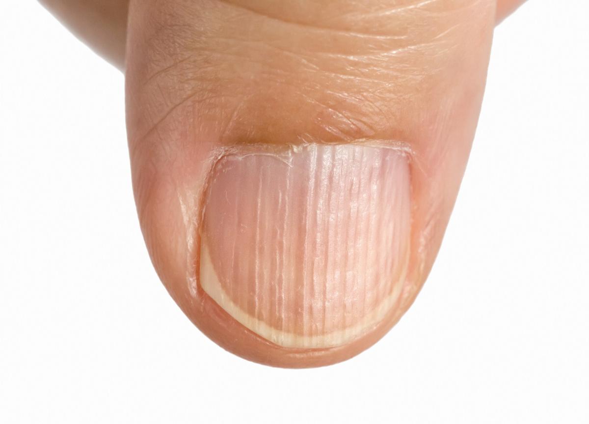 How to Get Rid of Fingernail Ridges