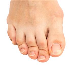 Closeup foot with a cracked and peeling toe nail