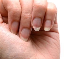 Broken Nail - Female Hand