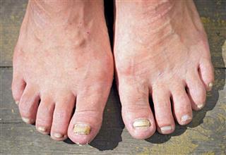 Onychomycosis with fungal nail infection