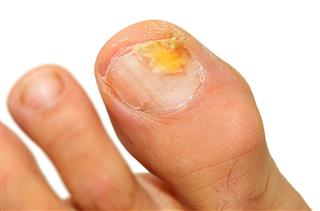 Onychomycosis fungal infection of the nail