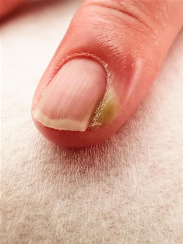 Paronychia infection of a finger