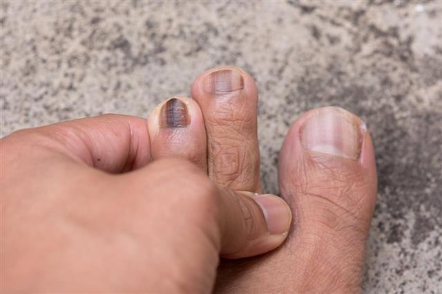Close up of Nail infections