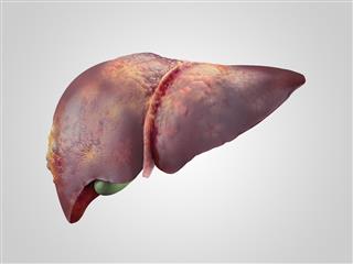 Sick human liver with cancer