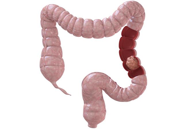 3D demonstration of colon with one part highlighted