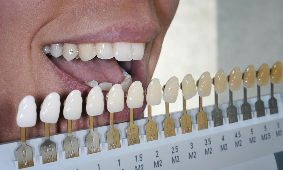 Teeth Bonding Cost