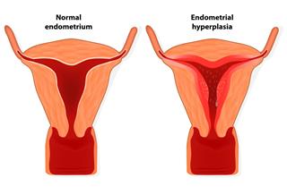 Endometrial hyperplasia