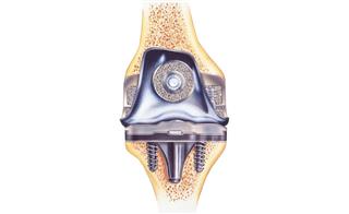 Knee - Total Replacement - Showing Cutaway view of Implant