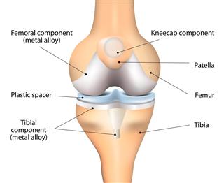 Components of a Knee Replacement