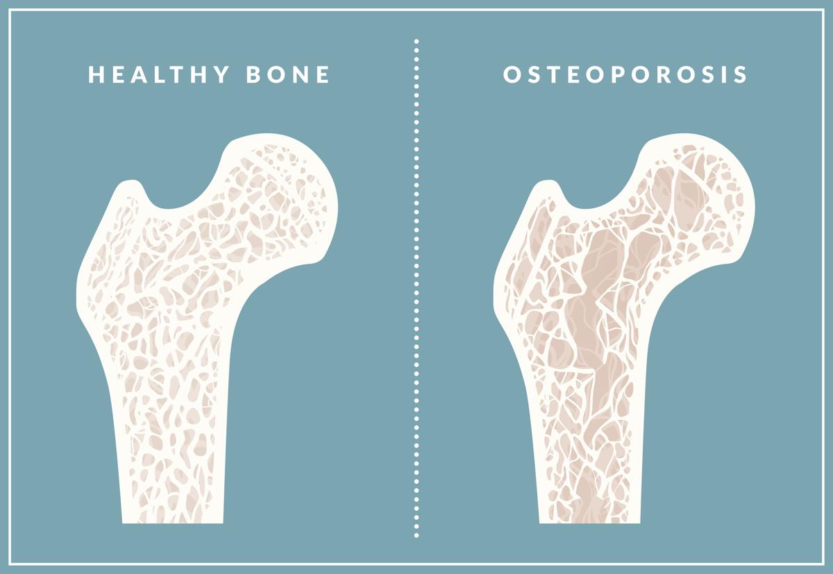 Osteoporosis in Women