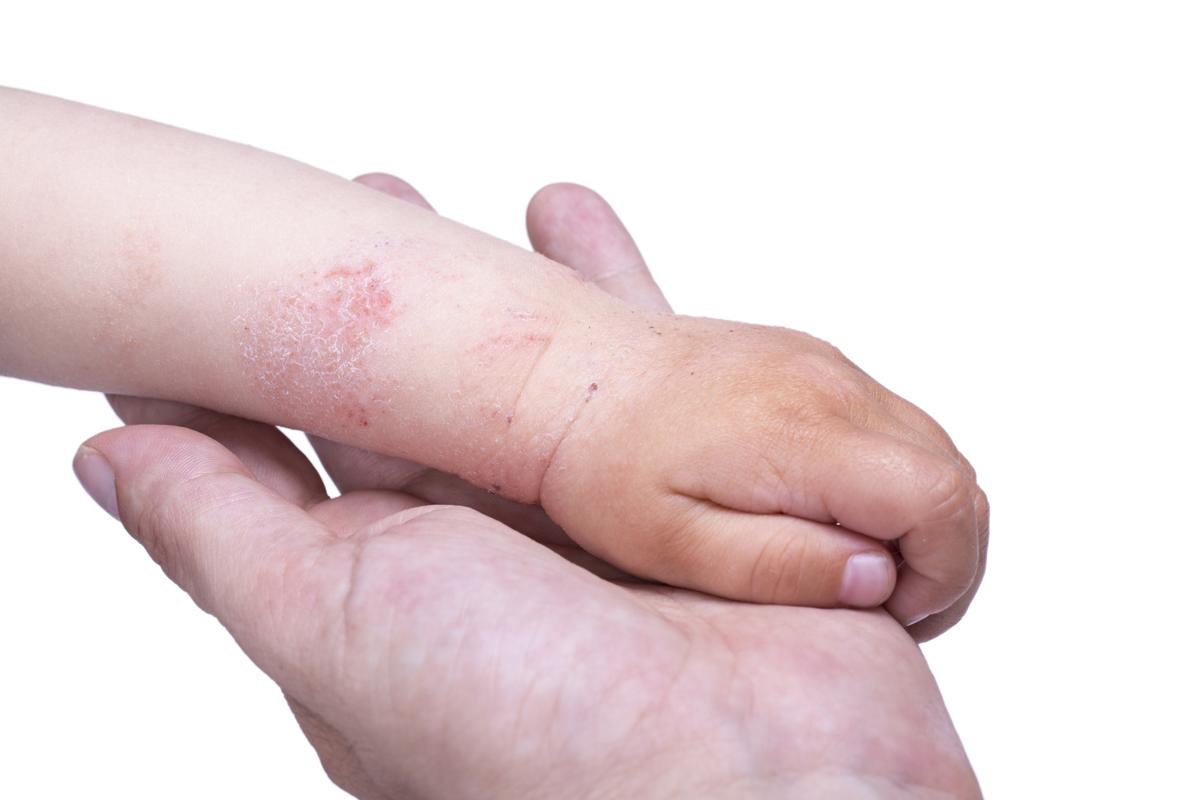 How to Get Rid of Eczema on Arms