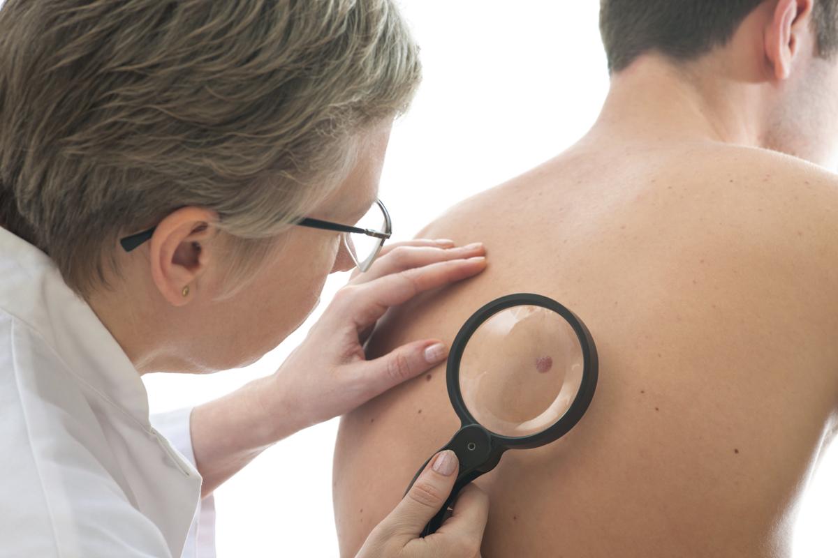 Skin Cancer - Causes and Treatment