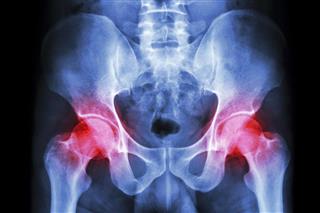 Film x-ray human's pelvis and arthritis at both hip joint