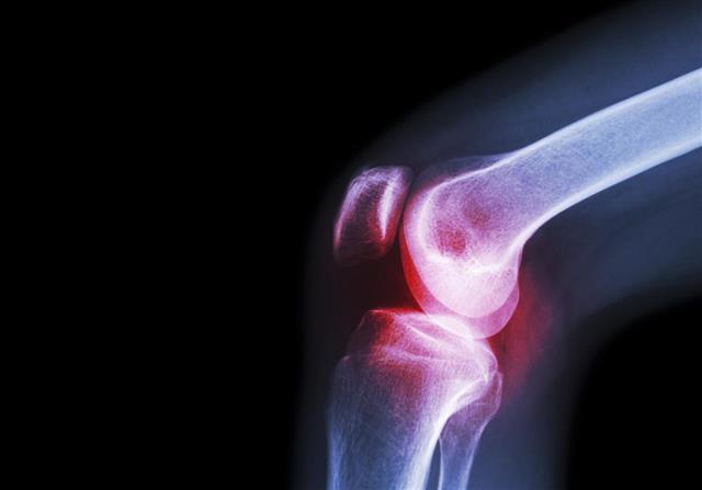Film x-ray knee joint with arthritis