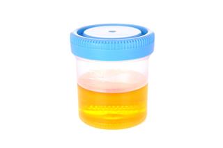 Urine sample in a translucent cup on a white background