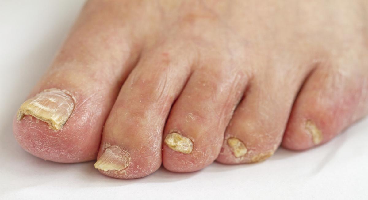 How to Get Rid of Foot Fungus