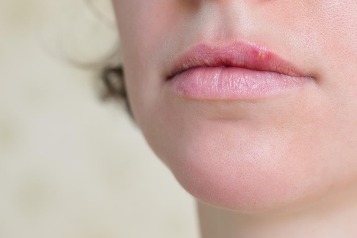 How to Heal a Cold Sore