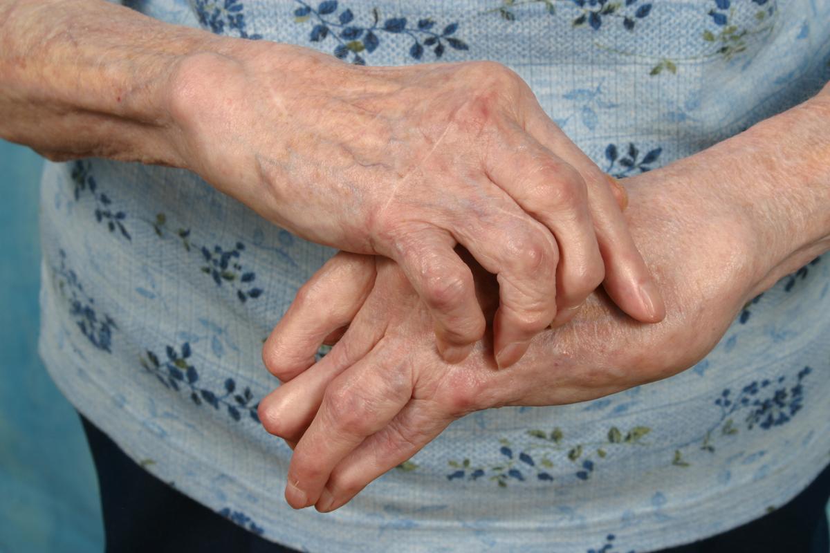 Arthritis Symptoms in Fingers
