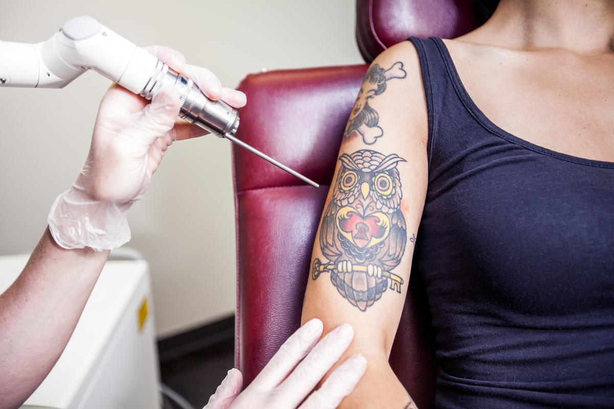 Laser Tattoo Removal Side Effects - Thoughtful Tattoos