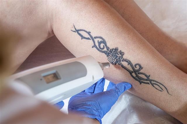 Laser tattoo removal from leg