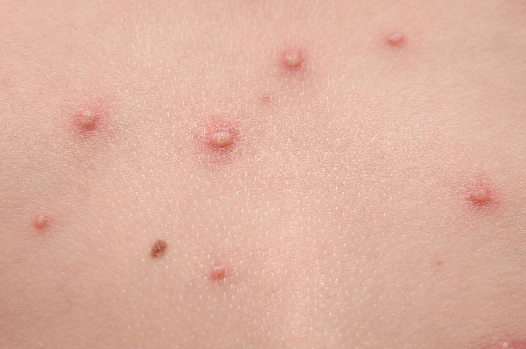 how-contagious-is-shingles