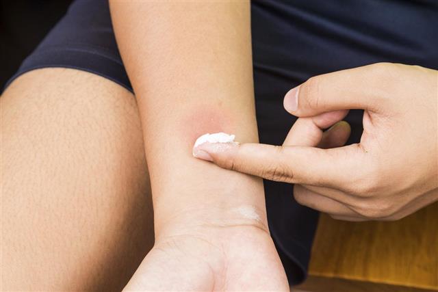 Baking soda being used to relieve itching from insect bites