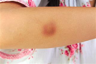 Bruise or hematoma on wounded girl arm