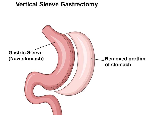 Cartoon illustration of Vertical Sleeve Gastrectomy
