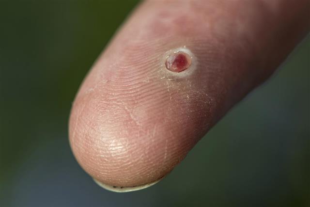 Pyogenic granuloma on a finger